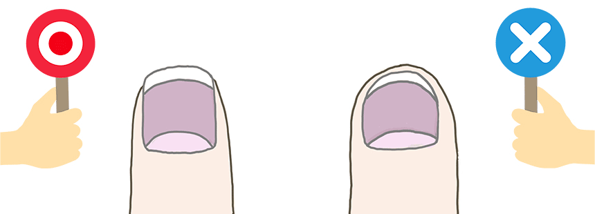 足の親指の「巻き爪」